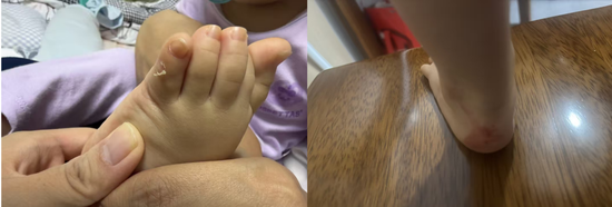 千元童鞋把脚穿肿?泰兰尼斯遭家长“围攻”,医生警惕影响发育,90%专利竟是外观设计 第3张 千元童鞋把脚穿肿?泰兰尼斯遭家长“围攻”,医生警惕影响发育,90%专利竟是外观设计 第3张